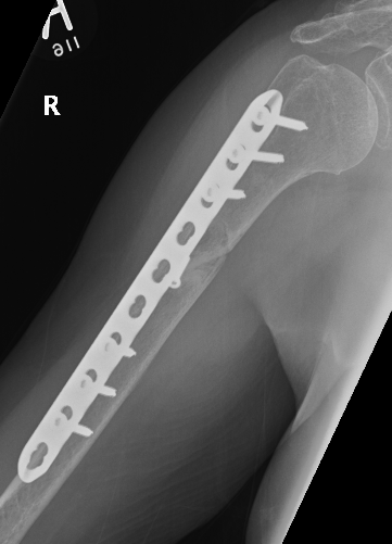 Humerus nonuion plate 1